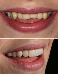 Composite bonding case before and after