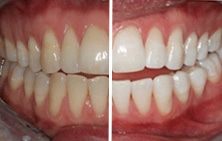 Teeth before/after whitening treatment