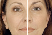 Woman before/after Resylane treatment